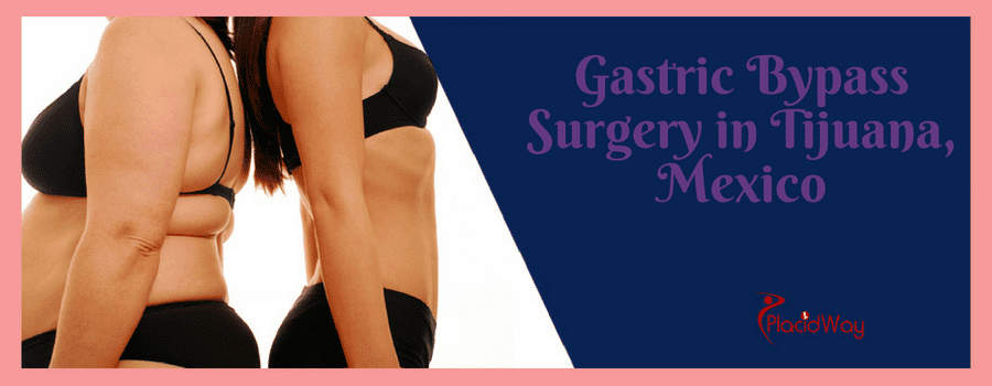 Gastric Bypass Surgery Tijuana Mexico